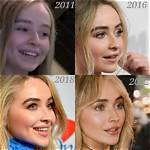Analyzing Sabrina Carpenter's Lip Filler Rumors: Truth or Fiction?