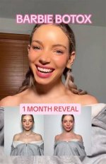 Barbie Botox: the Beauty Trend Taking the World by Storm