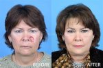 Before and After Plastic Surgery Photos Revealed ·
