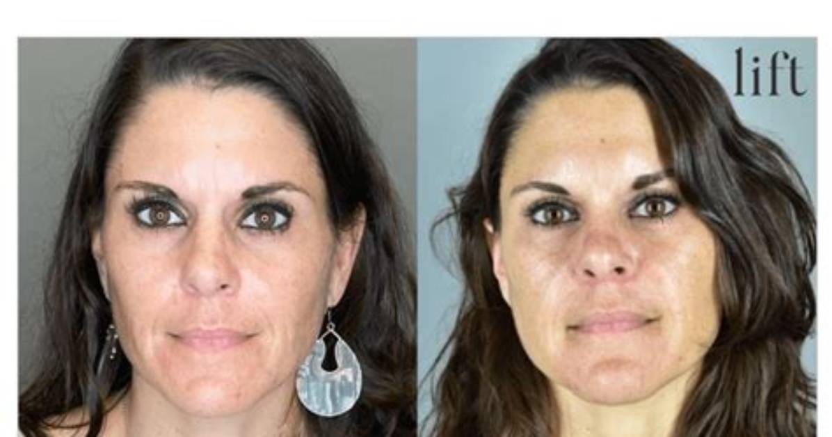 Botox Before and After Plastic Surgery Revelations