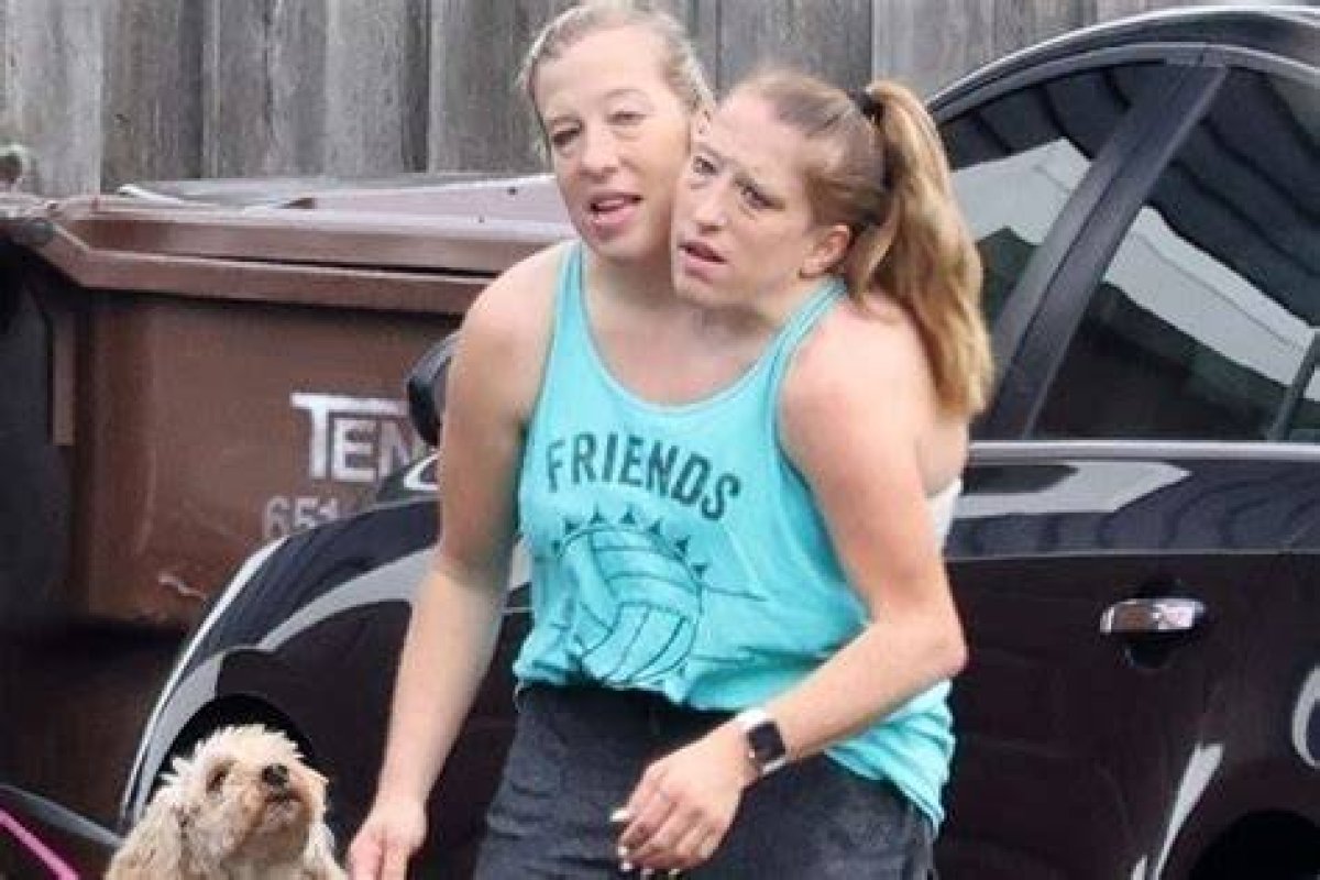 Did Abby and Brittany Die? Understanding the Lives of Conjoined Twins