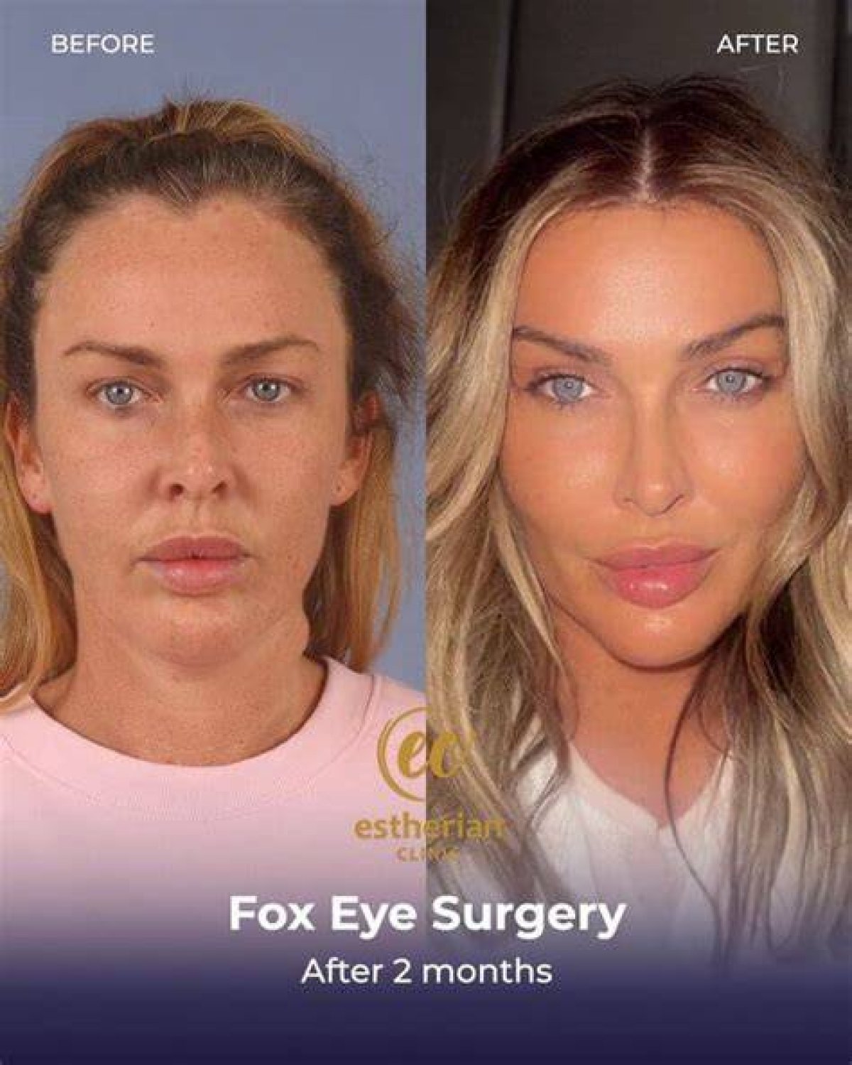 Discover the Secrets of Fox Eye Surgery: Before and After Revealed