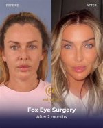 Discover the Secrets of Fox Eye Surgery: Before and After Revealed