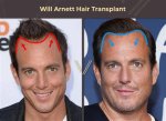 Does Will Arnett Wear a Wig? Murderville Actor Rumored to Have Had an Hair Transplant or Hair Plug-