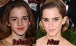 Emma Watson Plastic Surgery Before and After