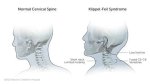 How Big Ed's Klippel-Feil Syndrome Has Affected Him