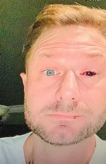 How Did Duane Ose Lose His Eye? Win the Wilderness Stars Eye Patch Explained Thu 30 April 20