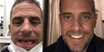 Hunter Biden's Teeth Transformation: a Comprehensive Review