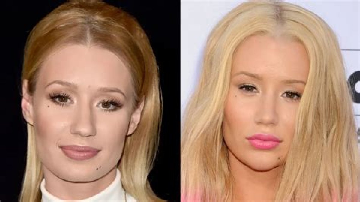 Iggy Azaleas Plastic Surgery Noticeable in Artwork for New Single Hollywood Life