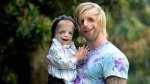 Inspiring Lives: Famous People with Treacher Collins Syndrome