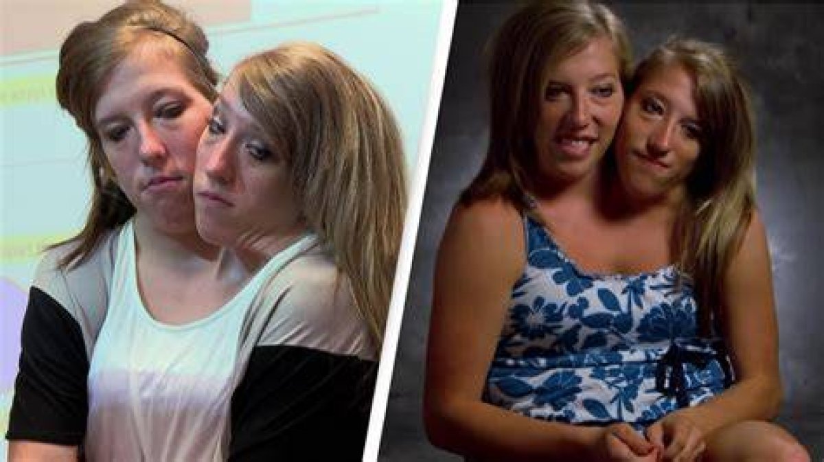 Life’s Twists: the Journey of Conjoined Twins Abby and Brittany Pregnant
