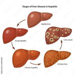 Liver Failure and Hepatitis C