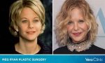 Meg Ryan Addresses Plastic Surgery Rumors in Glamour Interview