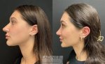 Moriah's Nose Job Transformation: Before and After