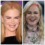 Nicole Kidman Procedures: a Comprehensive Look at Her Beauty Transformations