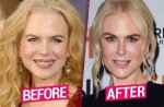 Nicole Kidman: the Facelift Journey of a Hollywood Icon
