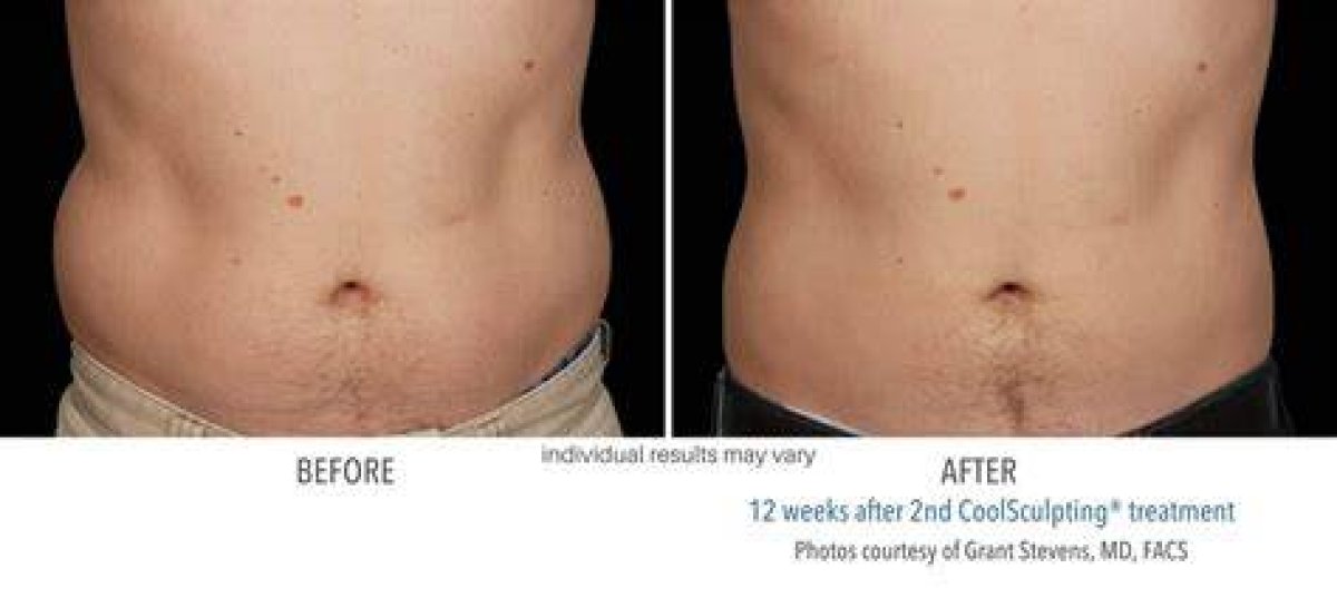 Results Gone Wrong: Cool Sculpting Before and After