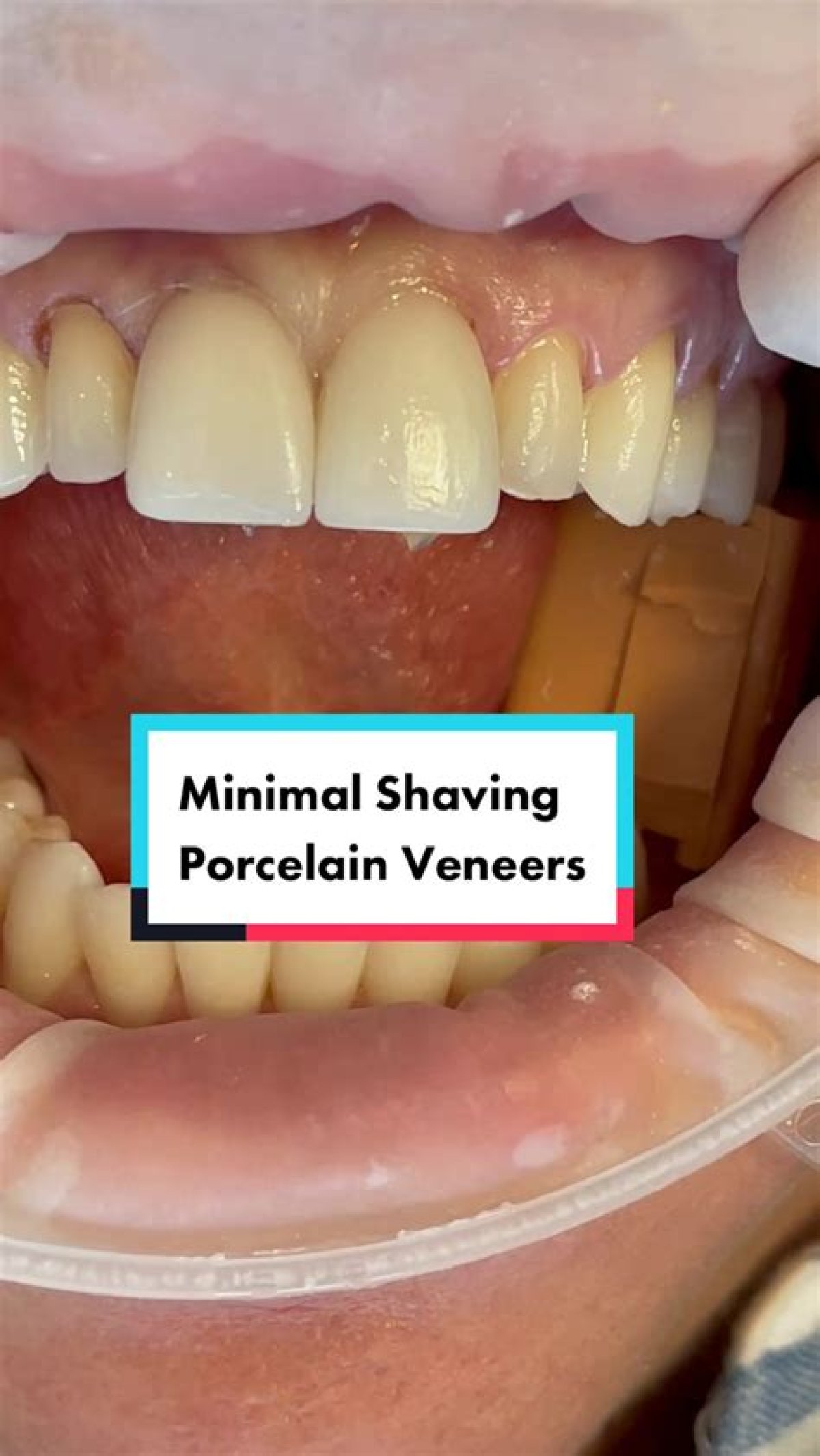 Teeth Shaving for Veneers: Why Tiktok's Shark Teeth Procedure Is Wrong and Dangerous, Accordin