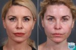 The Fine Line: When Plastic Surgery Becomes Overdone