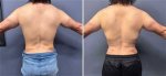 Transformative Journeys: Rib Removal Before and After