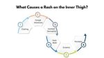 Understanding and Managing Inner Thigh Rash: a Comprehensive Guide