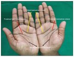 Understanding the Transverse Palmar Crease: Significance and Implications