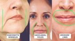 Unveiling Double Lip Lines: Appearance, Causes, and Significance