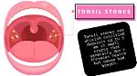 Unveiling the Tonsil Stones Tiktok Phenomenon: What You Need to Know